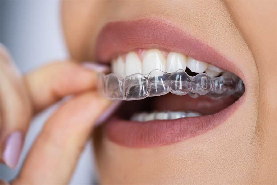 A closeup of a mouth putting in clear aligners one of many of our adult braces options