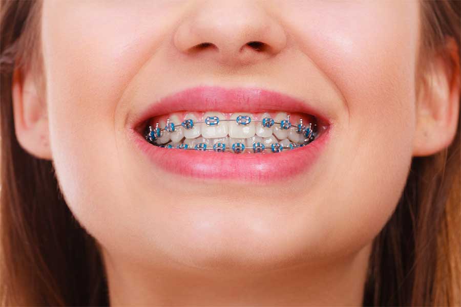 A closeup of a mouth with traditional metal braces one of many of our adult braces options