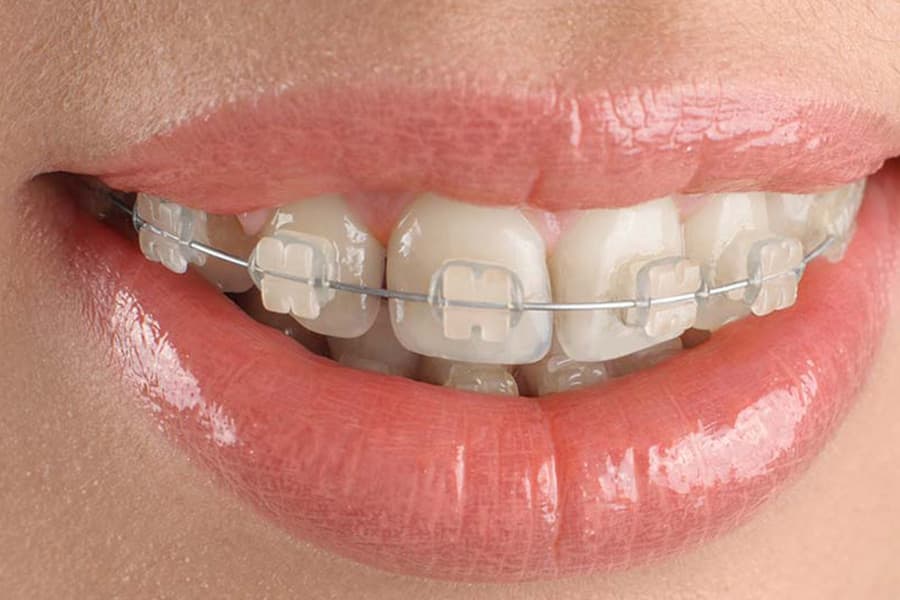 Types of Braces – Orthodude