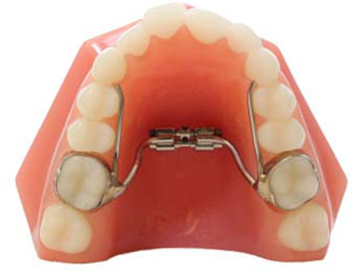 A close up of a Palatal Expanders on a dental mold for corrective treatment