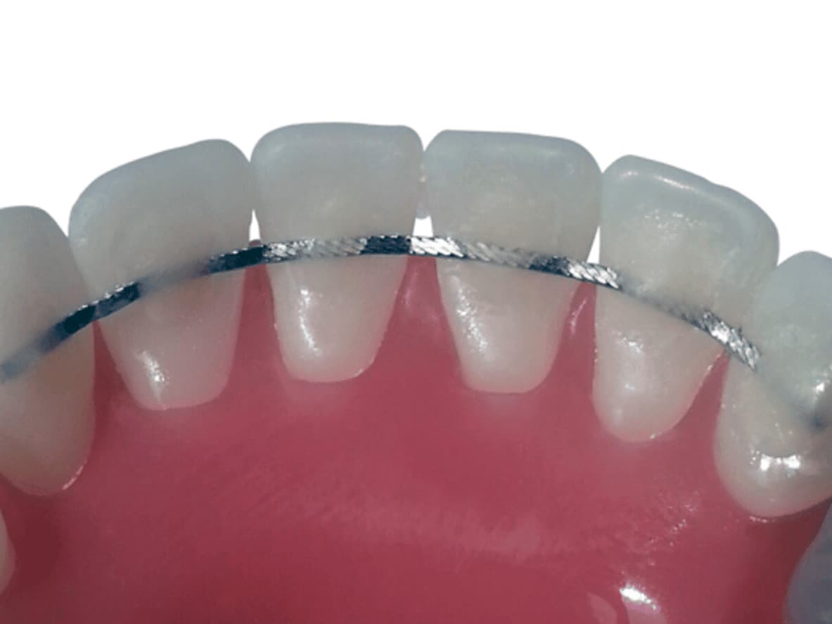 A close up of a permanent retainer used as corrective treatment
